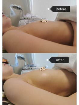 シークレット(Secret)/最新バストUP機器で驚きの効果