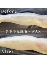 エピナ 横浜店(Epina)/メンズ脱毛/脚脱毛/足脱毛