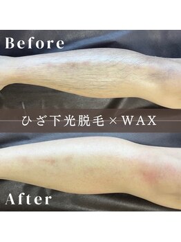 エピナ 横浜店(Epina)/メンズ脱毛/脚脱毛/足脱毛