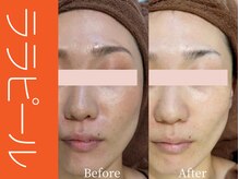 ビューティーリバース 横浜店/ララピール50分