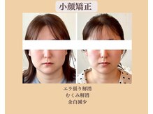 リフェイスフサエ(ReFace Fusae)