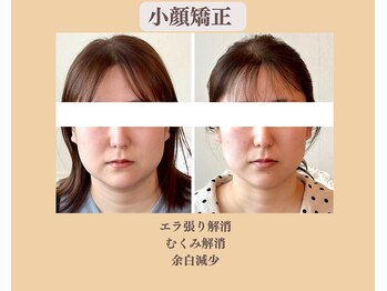 リフェイスフサエ(ReFace Fusae)