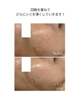 ユウドット(yuu.)/薄いシミにも！シミケア