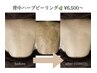 【お試し】剥離なし★ソフト・ハーブピーリング背中 6,500円