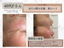 リボーン 柏(REBORN)/【シミケア&毛穴】肌印象アップ