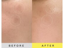 ソアン(Soin)/ダクトピール