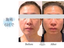 ディアスマイル(Dear.smile)/施術6回で