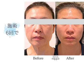 ディアスマイル(Dear.smile)/施術6回で