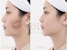 アリリィ(ARILY)/インディバダウンタイム/表参道