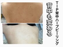 ハービー(Herbee)/背中ハーブピーリング