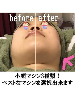 フロージア 新宿南口店(FLOGIEIA)/小顔ハーブピーリングフロージア