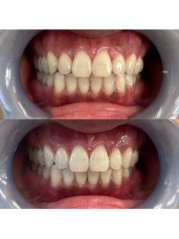 おうちサロン しゅろ/プレミアムセルフホワイトニング