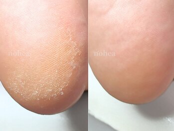 ルーム ノヘア(Room nohea)の写真/【自信の持てる素足に◎】可愛い靴を履きたいけどケアができていない…そんな方にもおすすめ☆