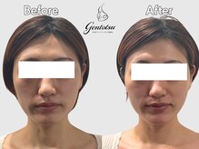 ゲントツ 新宿/小顔　小顔矯正