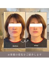 ルフレ(Reflet)/ほうれい線消えた