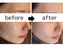 パールホワイトニングサロン 茅ヶ崎店/ハーブピーリング