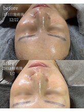 サロンナナジュウニ(Salon72)/肌荒れ/くすみ