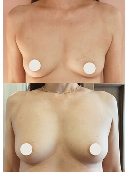 プレジール/バストボリュームアップ