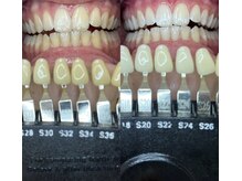 トウキョースワーズ 渋谷店(TOKYO SWRS)/#ホワイトニング #渋谷 #池袋