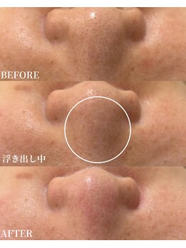 エース(ACE.)/鼻の黒ずみ毛穴改善☆