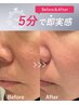 【2回目以降の方】光フェイシャル11,00→10,000