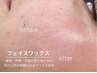 【顔脱毛｜選べるワックス】角質毛穴スッキリ◎気になるパーツ2箇所 ¥4000
