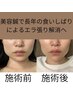 【噛みしめや食いしばりにお悩みなら】気になるエラ張り、美容鍼でスッキリ