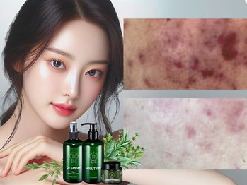 ウィア スキンサロン(Uvia skin salonk)の写真/剥離なしでに即美肌になれると韓国でも話題【OHLハーブピーリング】当日化粧もOK!肌トラブル改善に抜群!