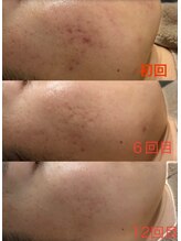 ミリミリ(mili mili)/ハーブ＋プラズマ