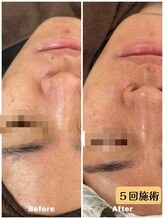 雅凪/ハーブピーリング　男性も大歓迎