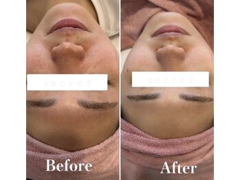 アミティエ 五反田店(Amitie)/顔脱毛×毛穴洗浄×美容液導入