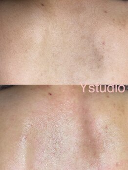 ワイスタディオ(Y studio)/背中ワックス脱毛