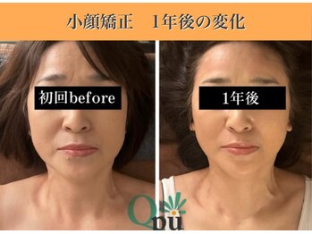 キュープ 表参道店(Qpu)/続けた方しか感じられない変化♪