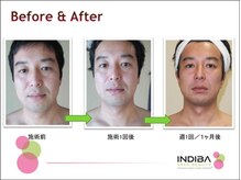 グラン セノーテ(Gran Cenote)/インディバでリフトアップ
