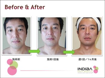 グラン セノーテ(Gran Cenote)/インディバでリフトアップ