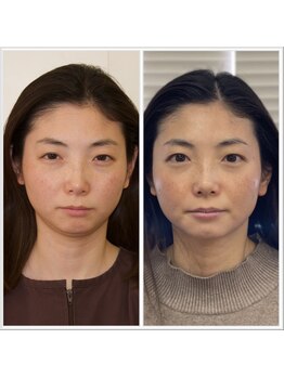 ビューティーパンク 黒田鍼治療院(Beauty Punc)/14.ここで終了