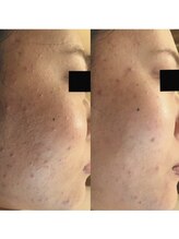 ホワイトアクア 梅田本店(WHITE AQUA)/ララピール/大阪/梅田/毛穴/小顔