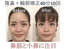 ラプリ 大阪心斎橋店(Raplit)/隆鼻＋輪郭矯正40分10回
