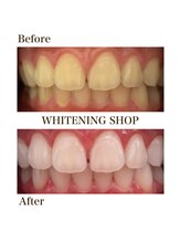 ホワイトニングショップ 一関店/5回照射後のbefore→after