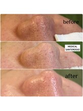 メディカルサンテロッソ 福岡店(MEDICAL SANTEROSSO)/韓国式３D毛穴洗浄+導入