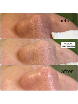 メディカルサンテロッソ 福岡店(MEDICAL SANTEROSSO)/韓国式3D毛穴洗浄+導入