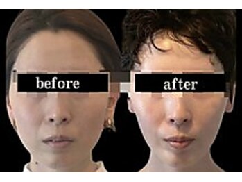 ワイズ 沖縄うるま院(Medical Y's)/糸リフト続ける絶対にボトサ