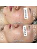 【肌悩み別対応◎肌質毛穴改善】プラズマフェイシャル肌改善美容液導入