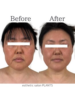 プランツ(PLANTS)/施術回数１回／たるみ・小顔