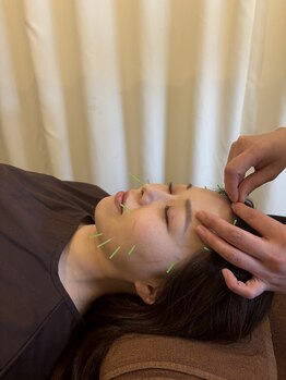 イリス 神田(iris)/リフトアップ美容鍼