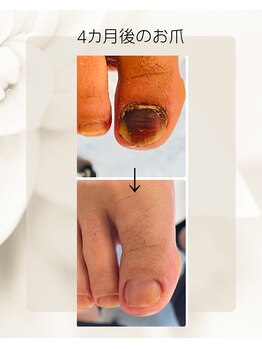 ミヨン 喜多見店(Miyong)/変形爪ケア