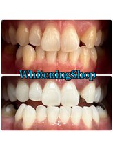 ホワイトニングショップ 吉祥寺店/BEFORE ＆ AFTER