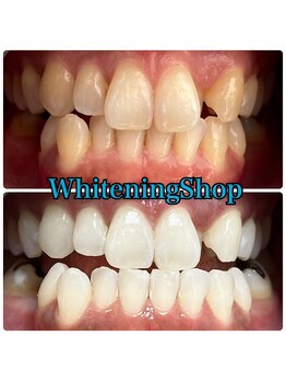 ホワイトニングショップ 吉祥寺店/BEFORE ＆ AFTER