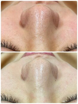 ルコル(LUCOL)/毛穴洗浄ハイドロフェイシャル