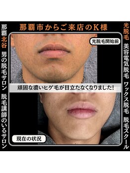 メンズディースタイル 首里店(Men's Dstyle)/那覇メンズ脱毛 Before After